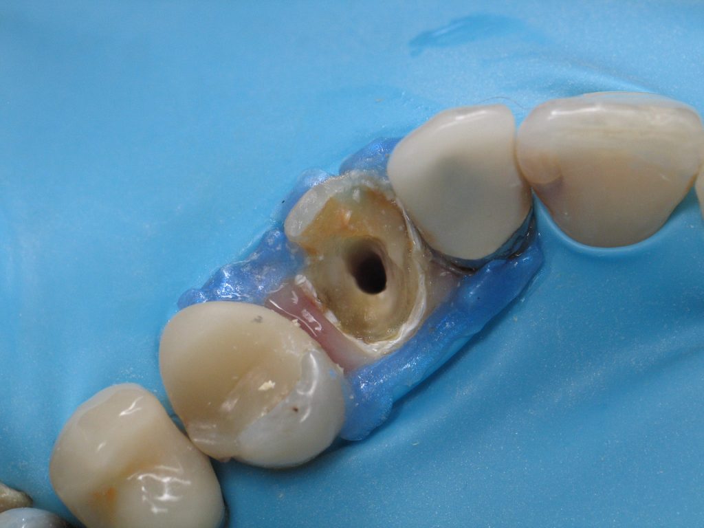 Rubber Dam Course Northwest Dental Academy Dr. Nadeem Younis