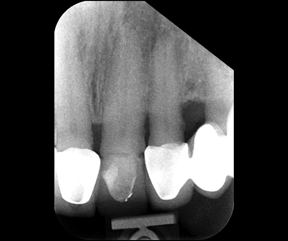 1 Day Intensive Hands On Endodontics Course Northwest Dental Academy