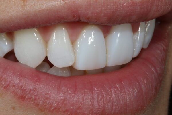 Anterior Composite Masterclass