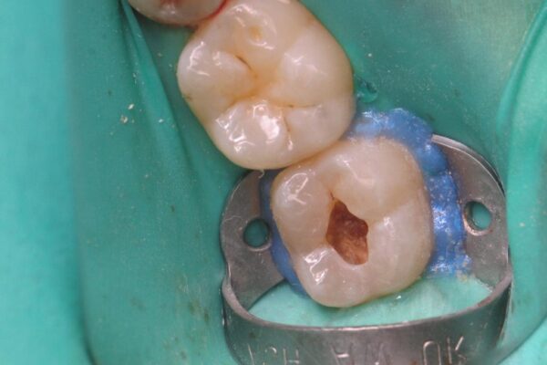 Posterior Composite Masterclass