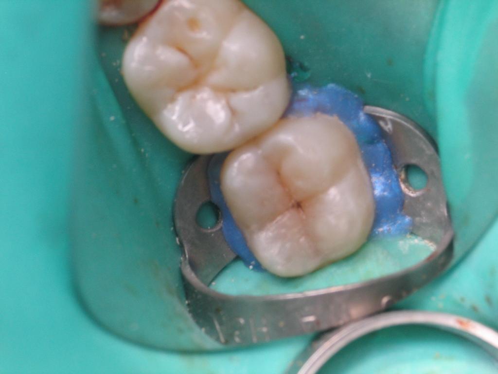 Posterior Composite Masterclass course photo