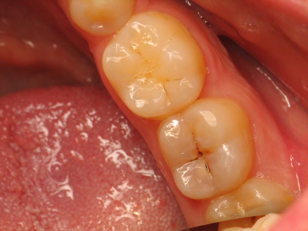 Posterior Composite Masterclass course photo