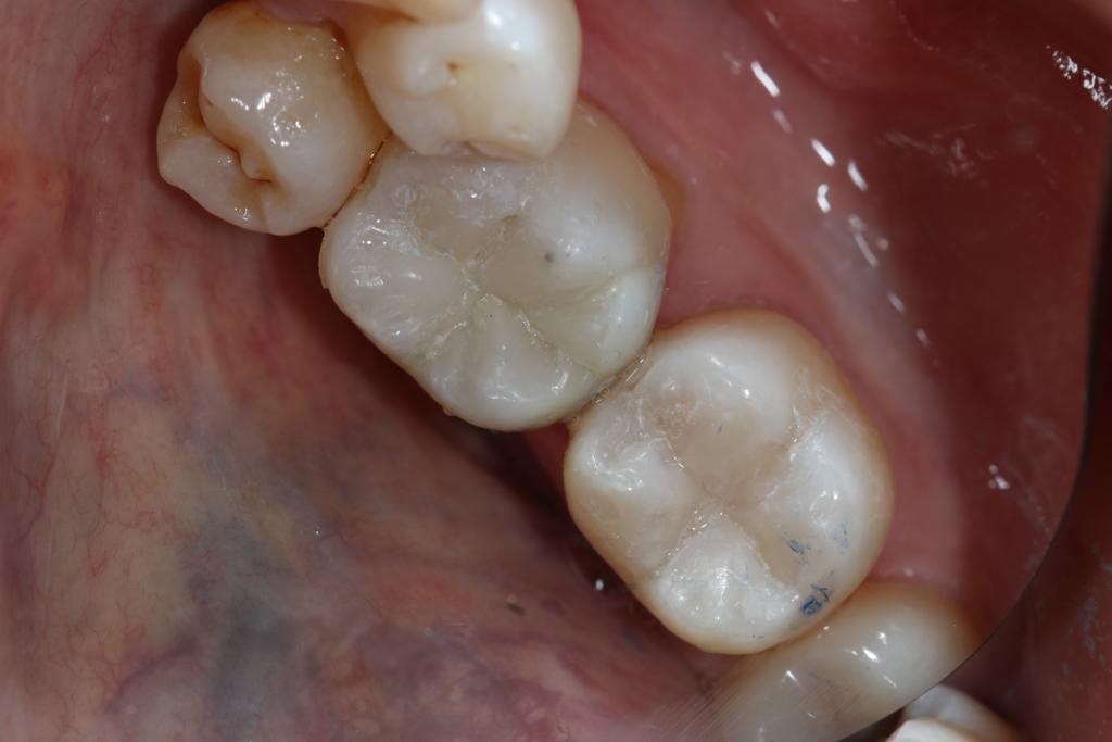 Posterior Composite Masterclass course photo