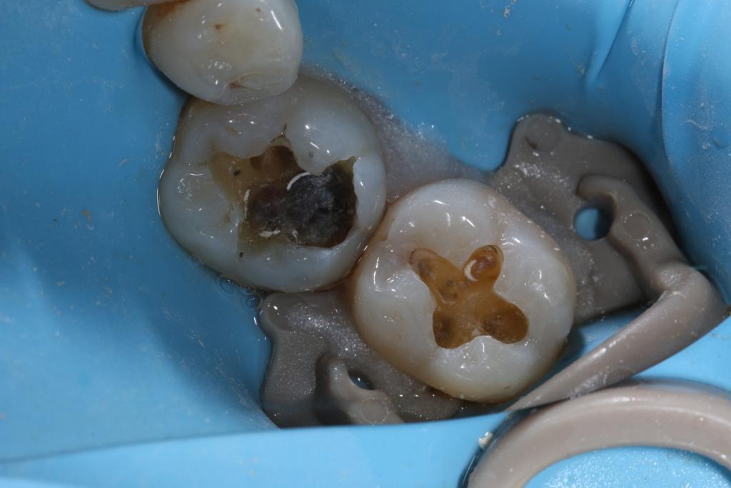 Posterior Composite Masterclass course photo